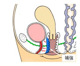 膣前壁補強縫縮術